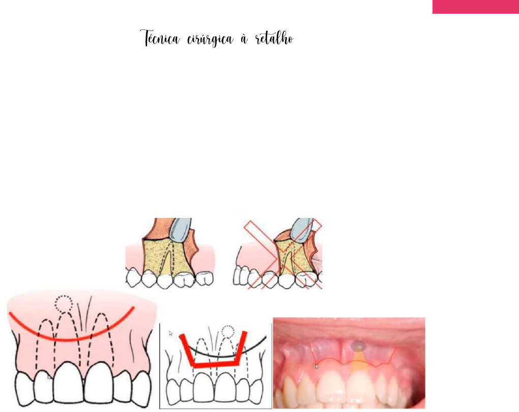 Tipos De Retalhos Odontologia Braincp