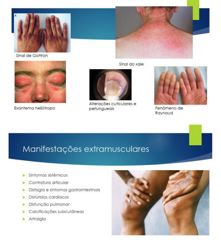 Dermatomiosite E Polimiosite Reumatologia