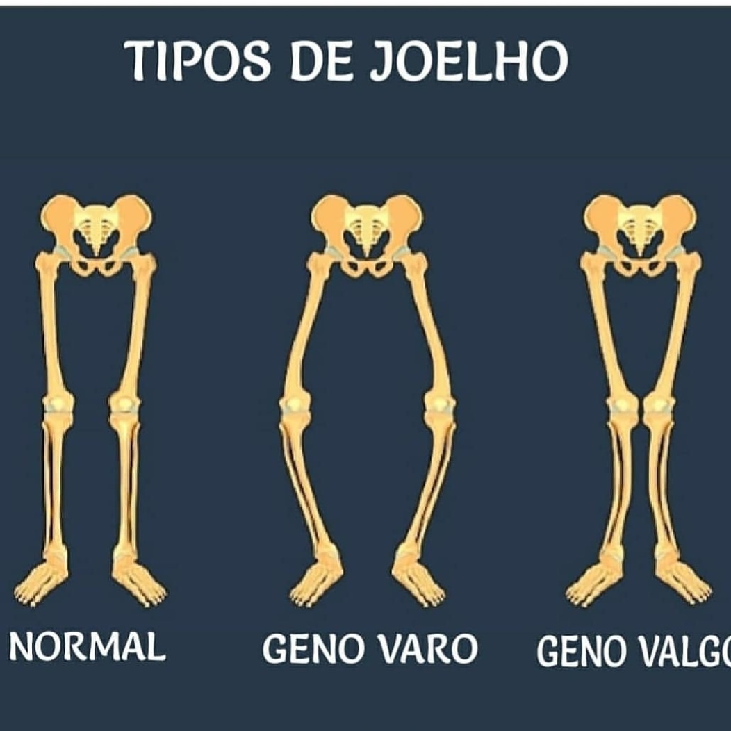 Tipos De Joelhos Fisioterapia