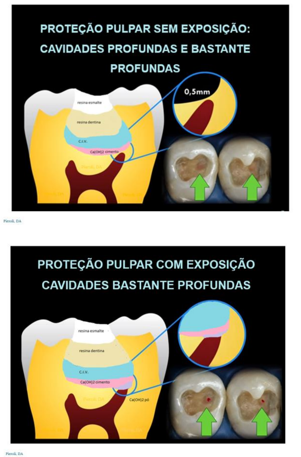 PROTEÇÃO PULPAR Dentística II