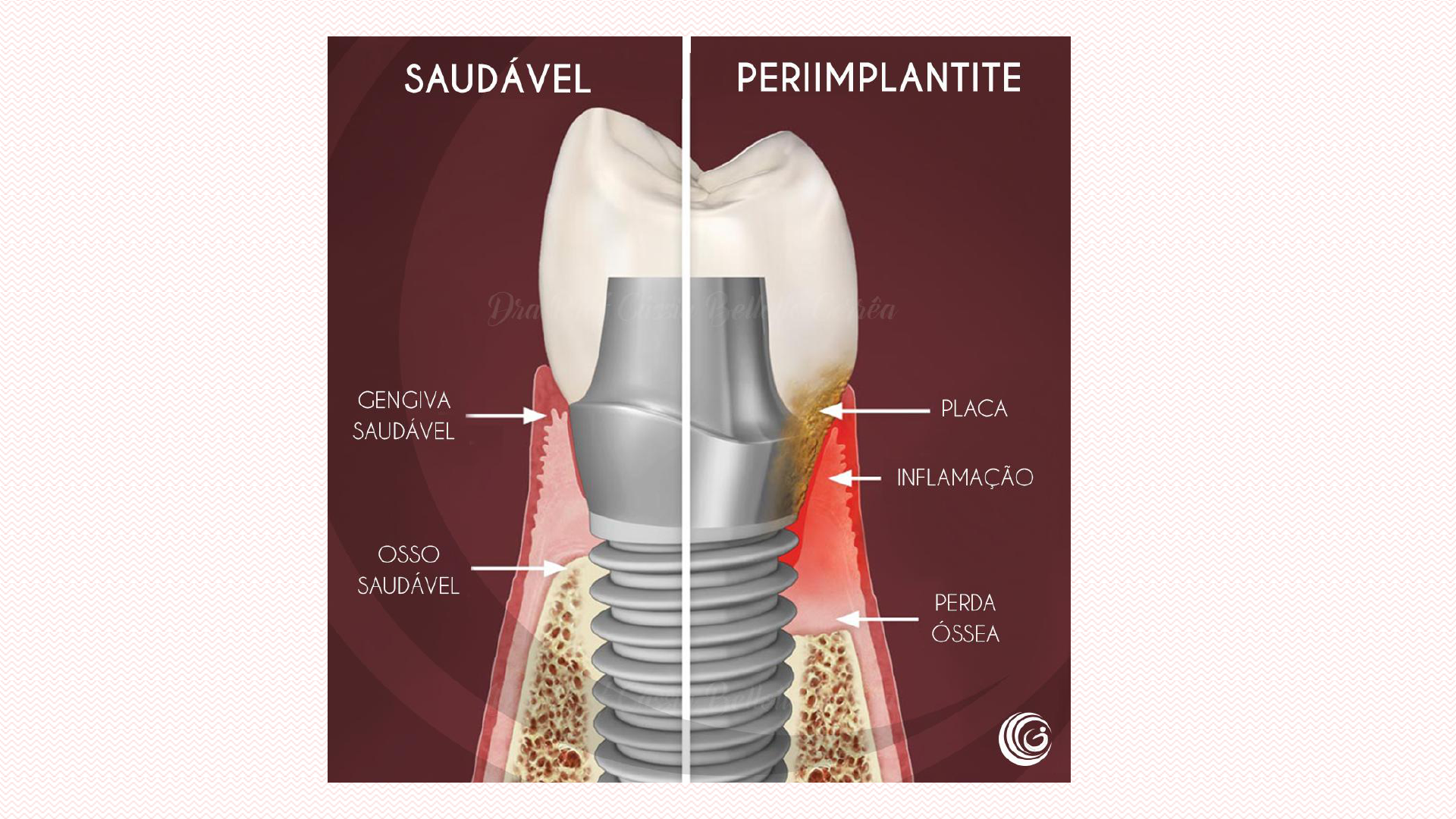 PERI IMPLANTITE PERIODONTIA DUDA Periodontia II