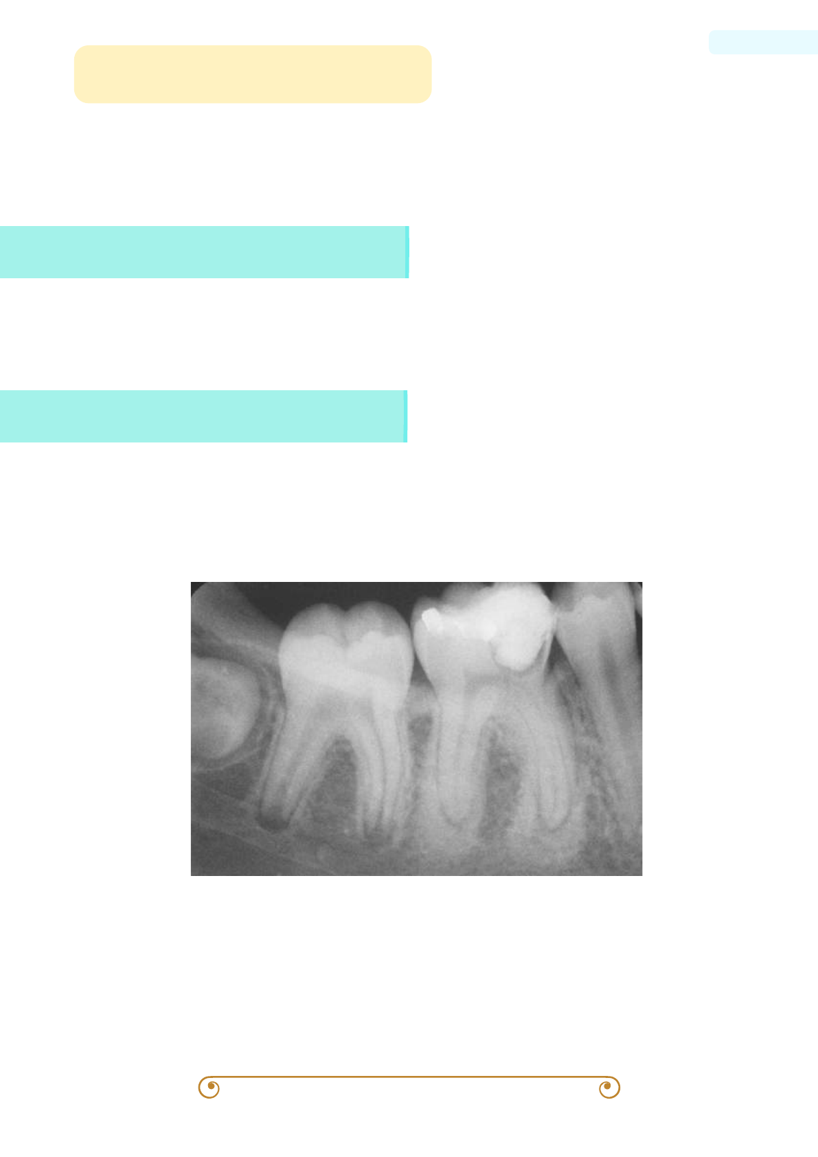 Osteomielite Esclerosante Focal