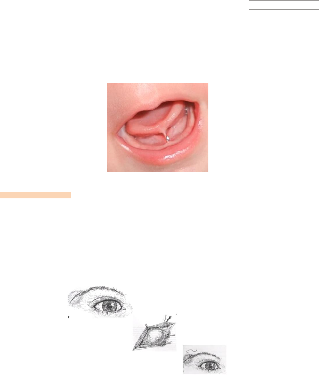 Opções de Cirurgia para Cisto Pilonidal que Você Não Sabia, image size:1064x1251