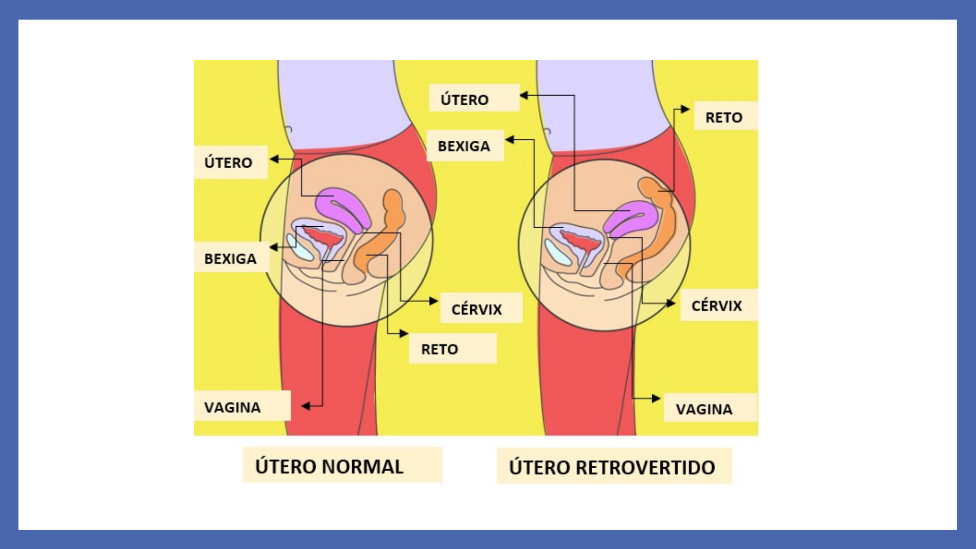 Exercicios De Utero Retrovertido Colo Do útero: Você Conhece A