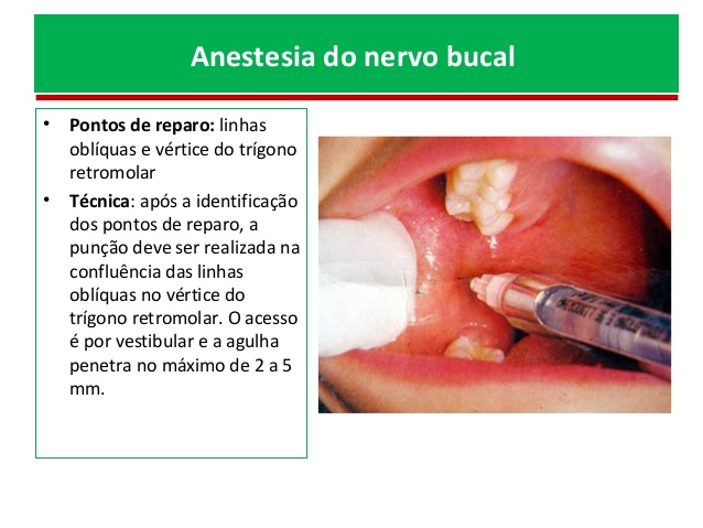 anestesia local em odontologia 72 638 anestésicos