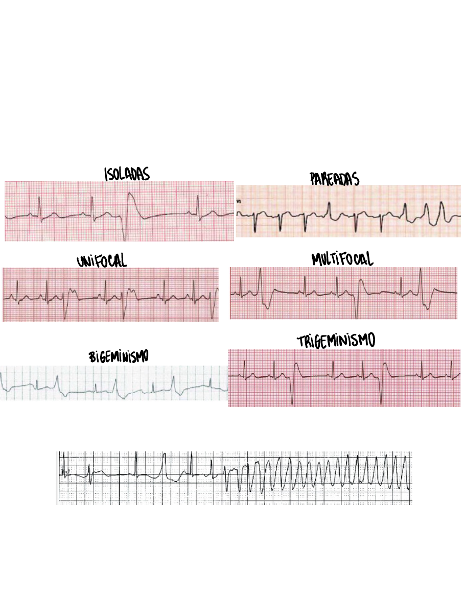 bigeminismo ventricular