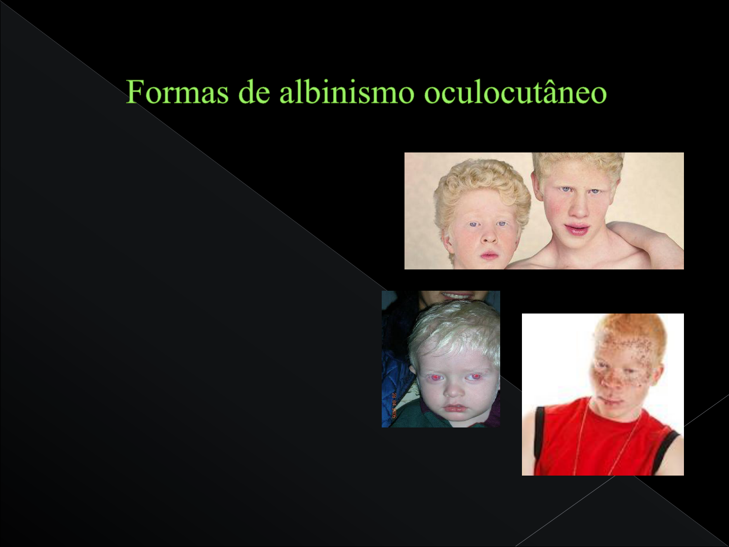 Grátis: albinismo - Material Claro e Objetivo em PDF para Estudo Rápido, image size:1440x1080