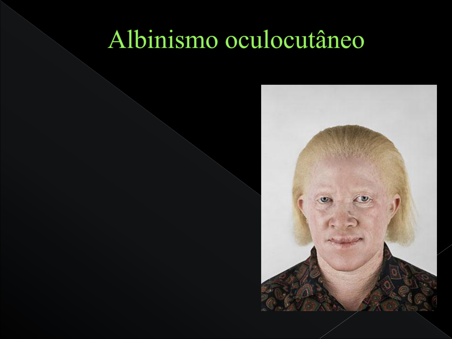 Grátis: albinismo - Material Claro e Objetivo em PDF para Estudo Rápido, image size:1440x1080