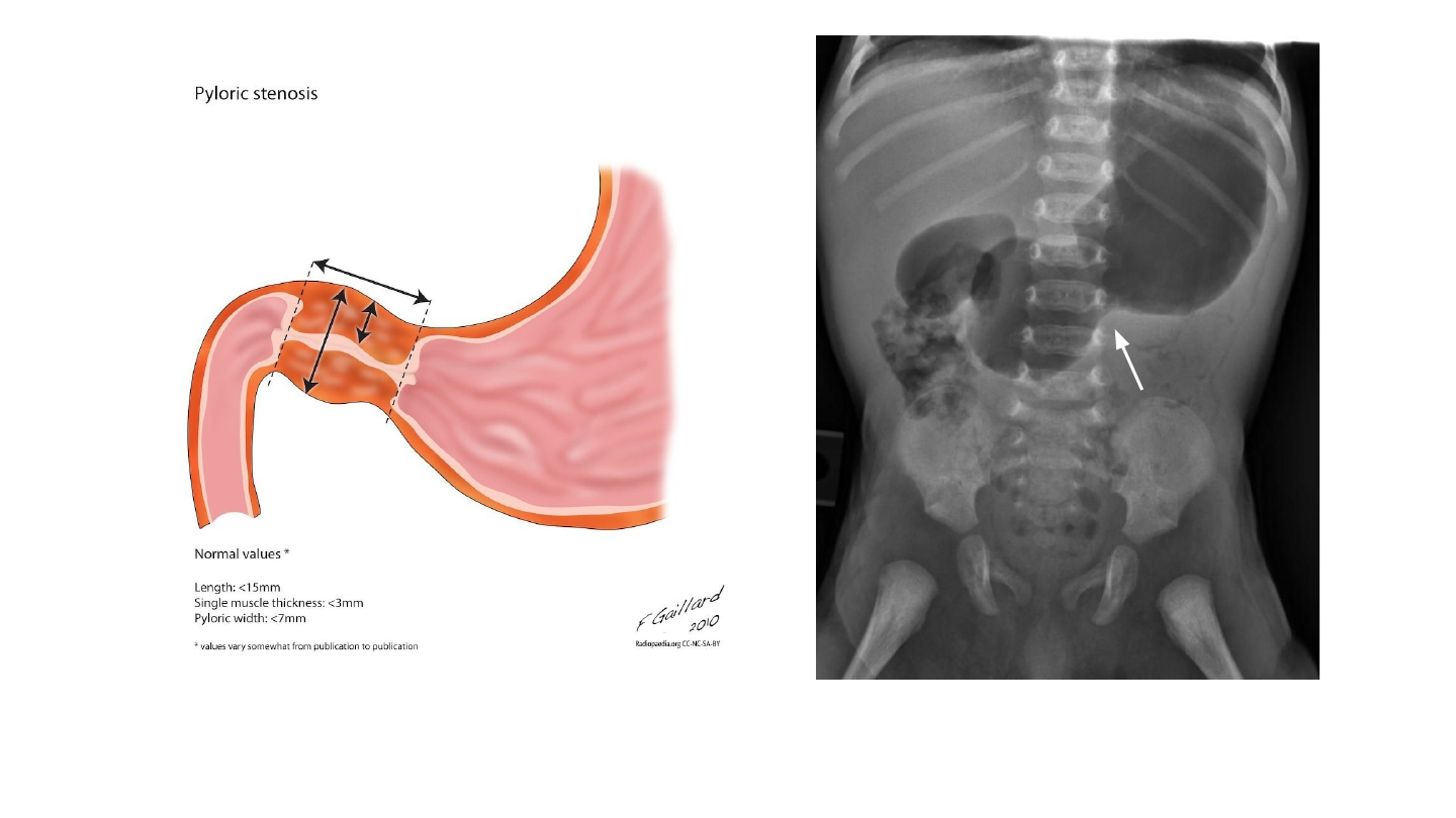 ESTENOSE HIPERTRÓFICA DO PILORO: UMA ABORDAGEM CLÍNICA E RADIOLÓGICA