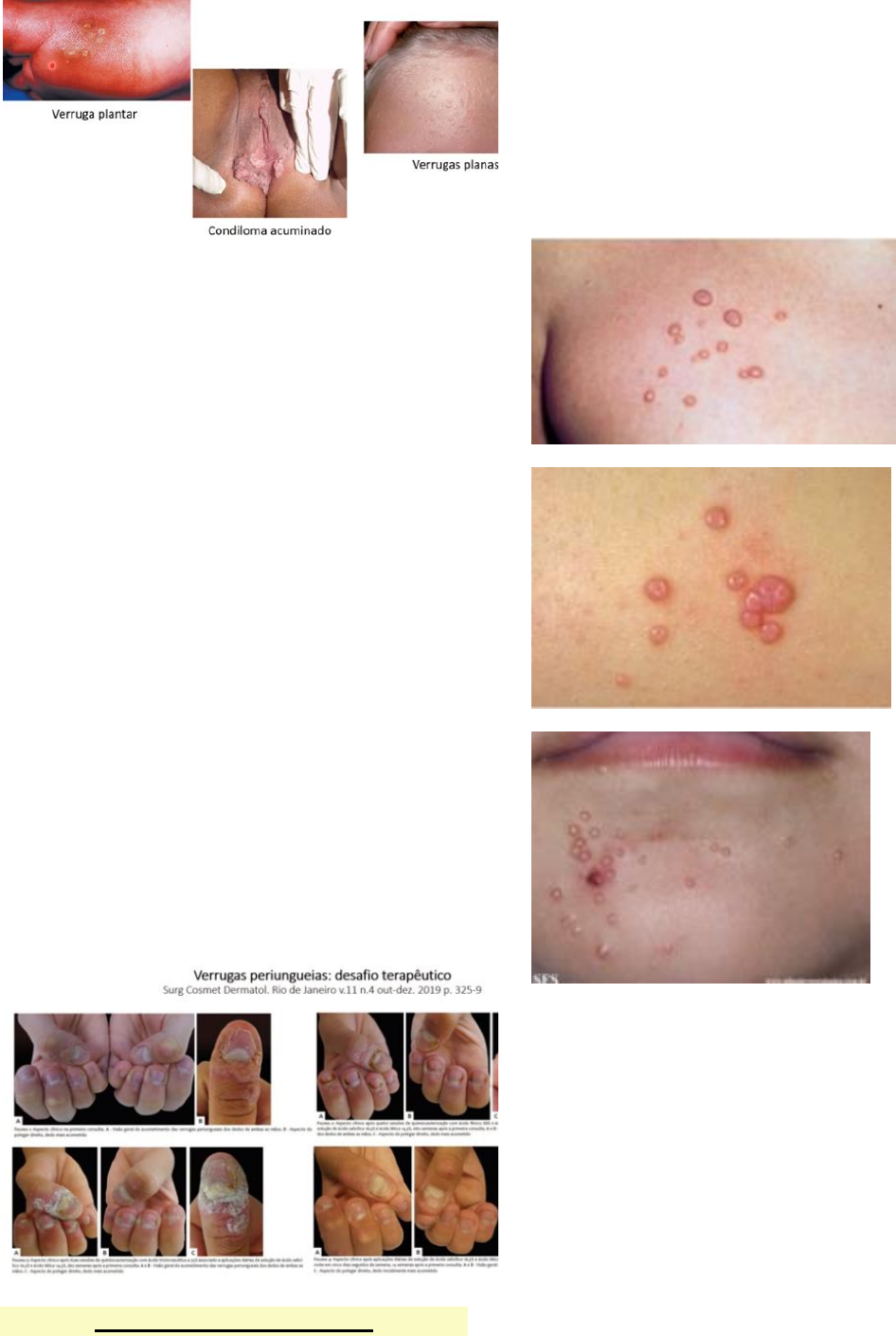 Grátis: Vírus Dermatológicos: Verrugas, Molusco Contagioso e Herpes -  Material Claro e Objetivo em PDF para Estudo Rápido, image size:946x1410