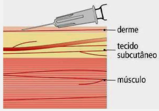 Intradermica Enfermagem