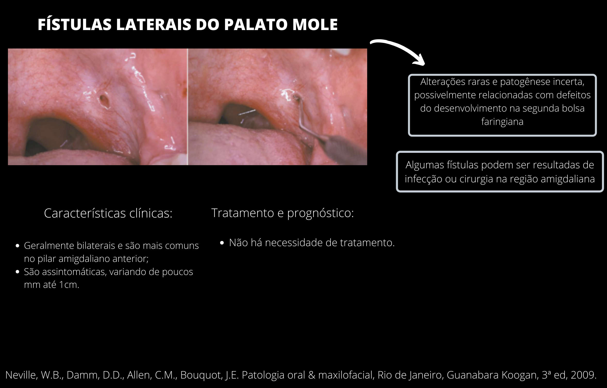 Fístulas laterais do palato mole Patologia Oral Fístulas laterais do palato mole Patologia Oral