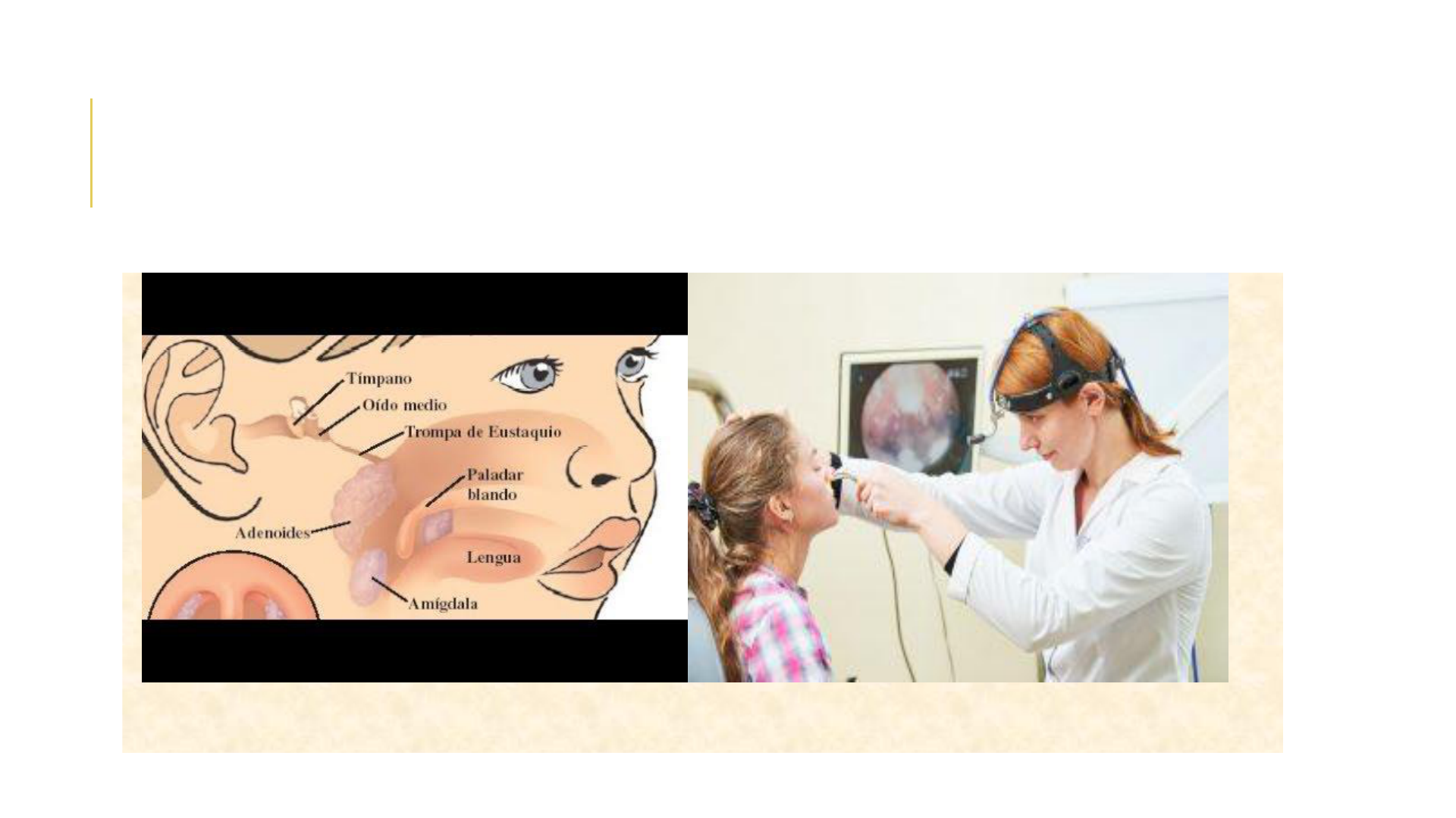 Grátis: HIPERTROFIA AMIGDALAS E DE ADENÓIDE [Salvo automaticamente] -  Material Claro e Objetivo em PDF para Estudo Rápido, image size:1920x1080