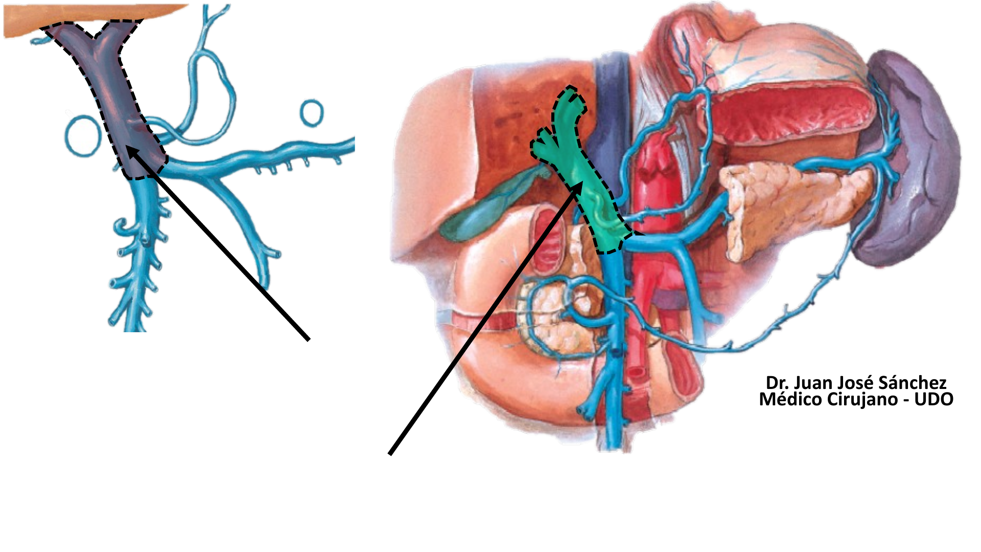 vena porta hepática hígado