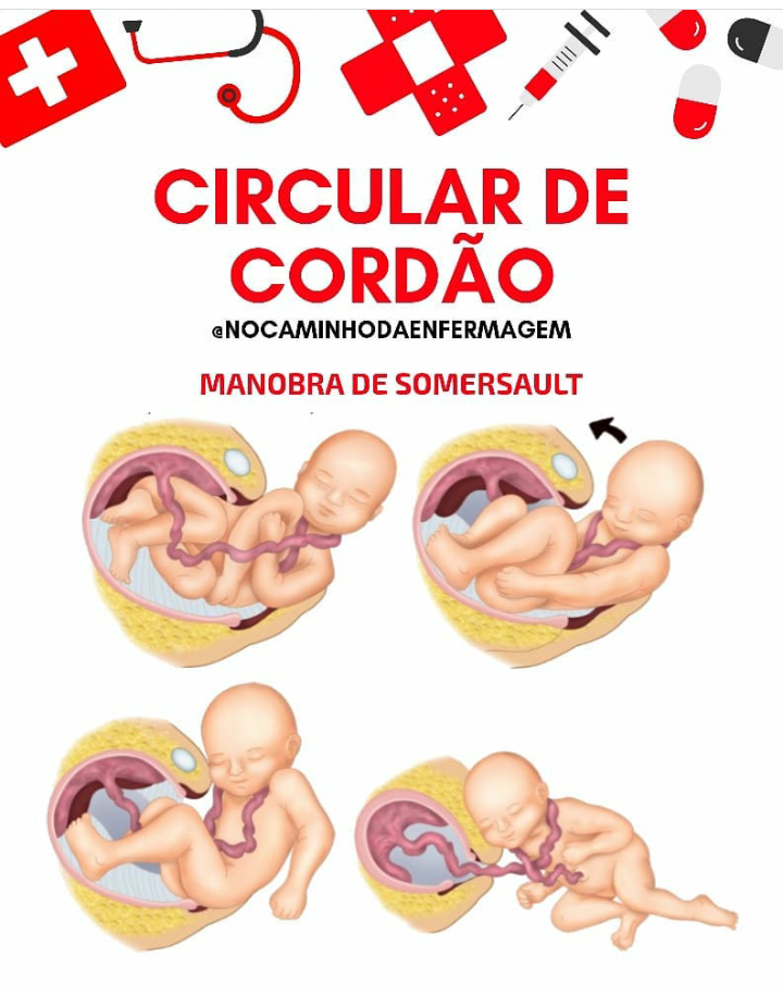 Circular De Cordão Manobra De Somersault Neonatologia E Obstetricia 4026