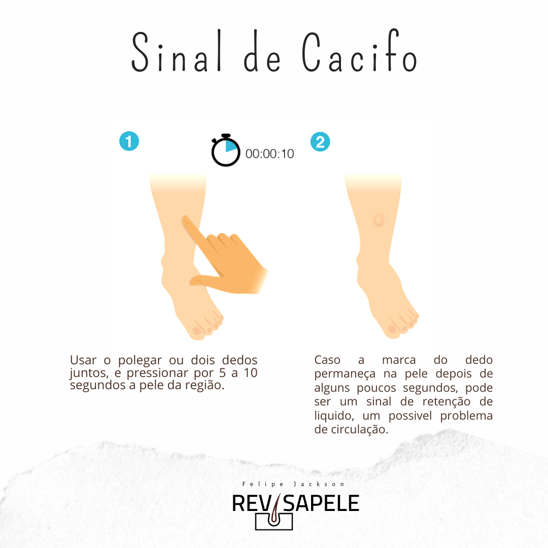 SINAL DE CACIFO ( EDEMA) - @revisapele - Fisioterapia Dermatofuncional