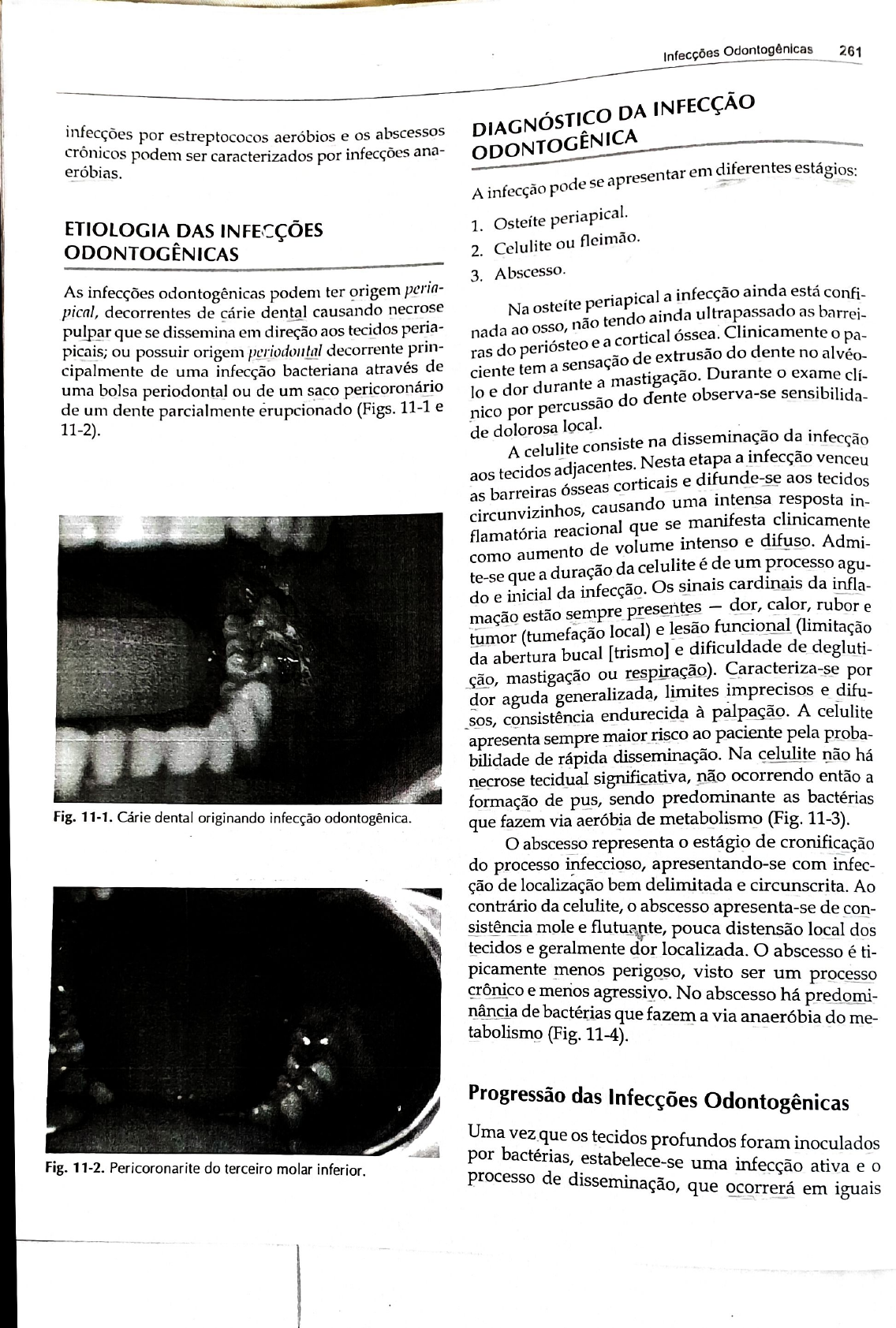 Infec Es Odontol Gicas Med Dent Ano Unizambeze Cirurgia Buco