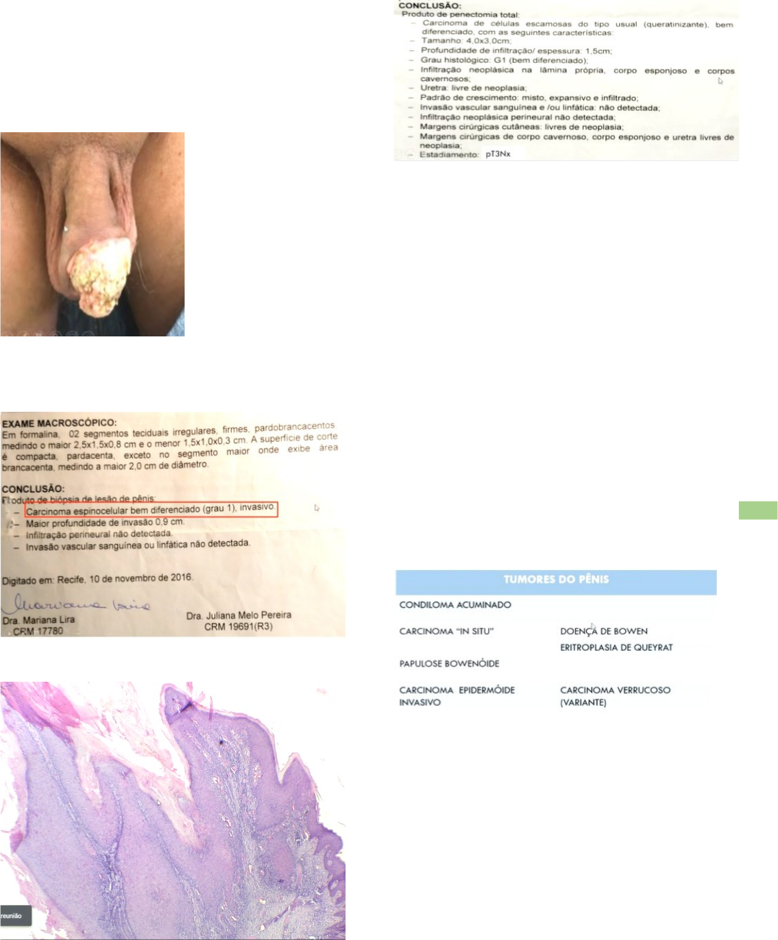 Grátis: Câncer de Pênis - Material Claro e Objetivo em PDF para Estudo  Rápido, image size:1135x1372