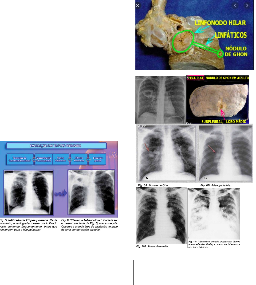 Tuberculose pulmonar. Radiografia de tórax de filme mostra fibrose,  cavidade, infiltração intersticial ambos os pulmões devido à infecção por  Mycobacterium tuberculosis . — Foto © stockdevil_666 #159020022, image size:1089x1213