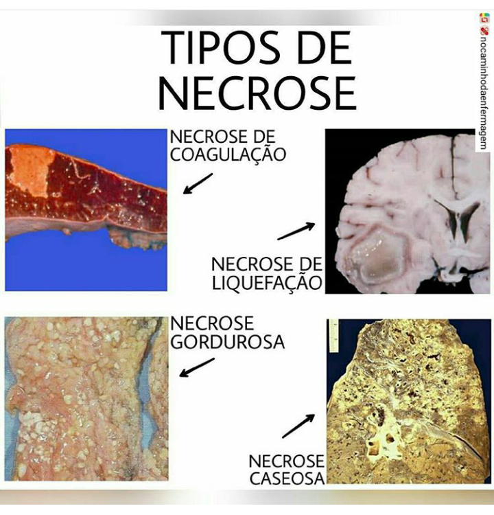 Tipos de necrose - Mapa Mental