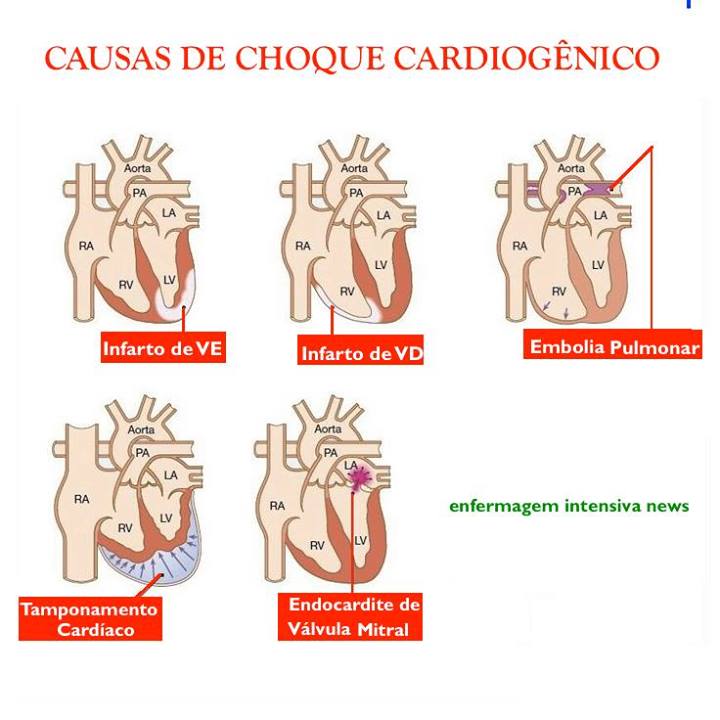 choque cardiogenico Patologia I