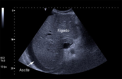 USG De Fígado- Ascite - Diagnóstico Por Imagem