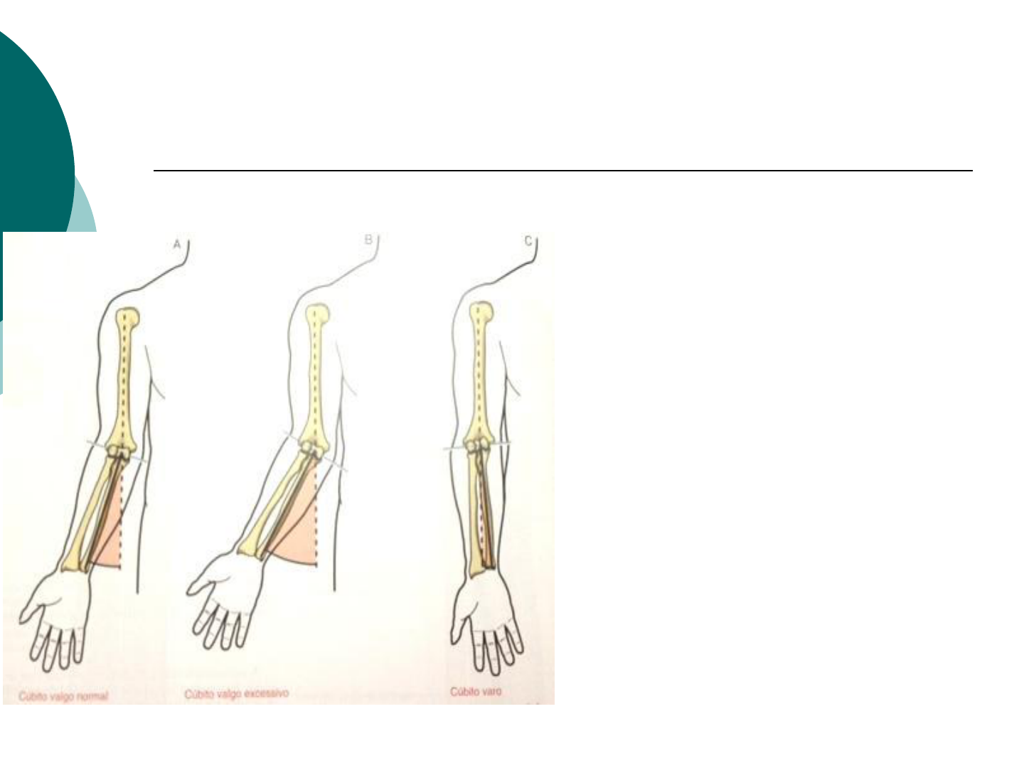 cúbito valgo y cúbito varo