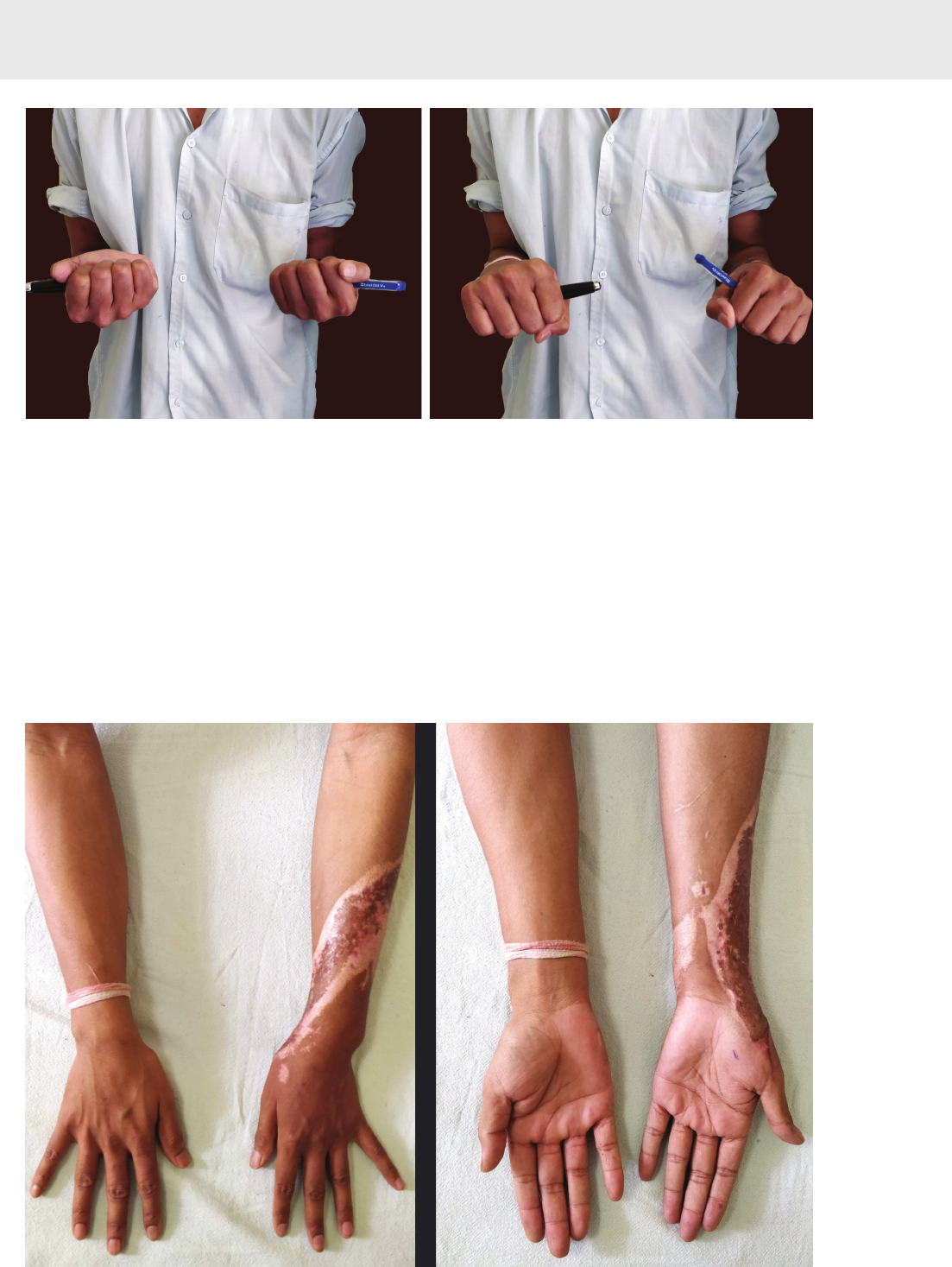 Cirurgia percutânea para o joanete 85 99182-9336 | TikTok, image size:1103x1467