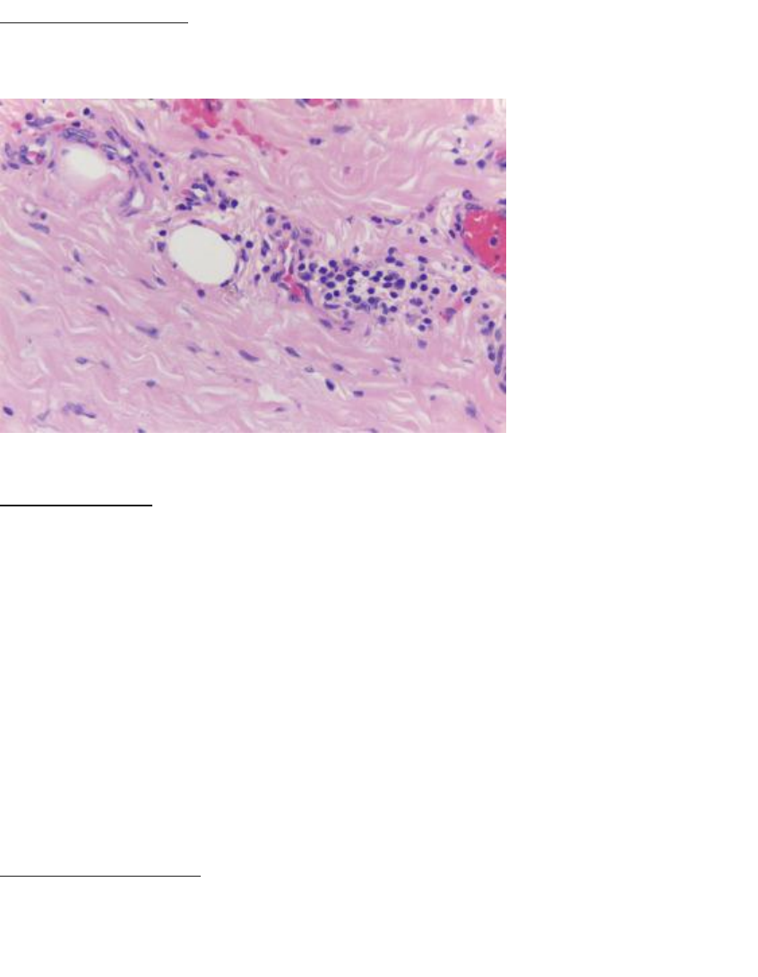 összefolyó és retikulált doxiciklin papillomatosis