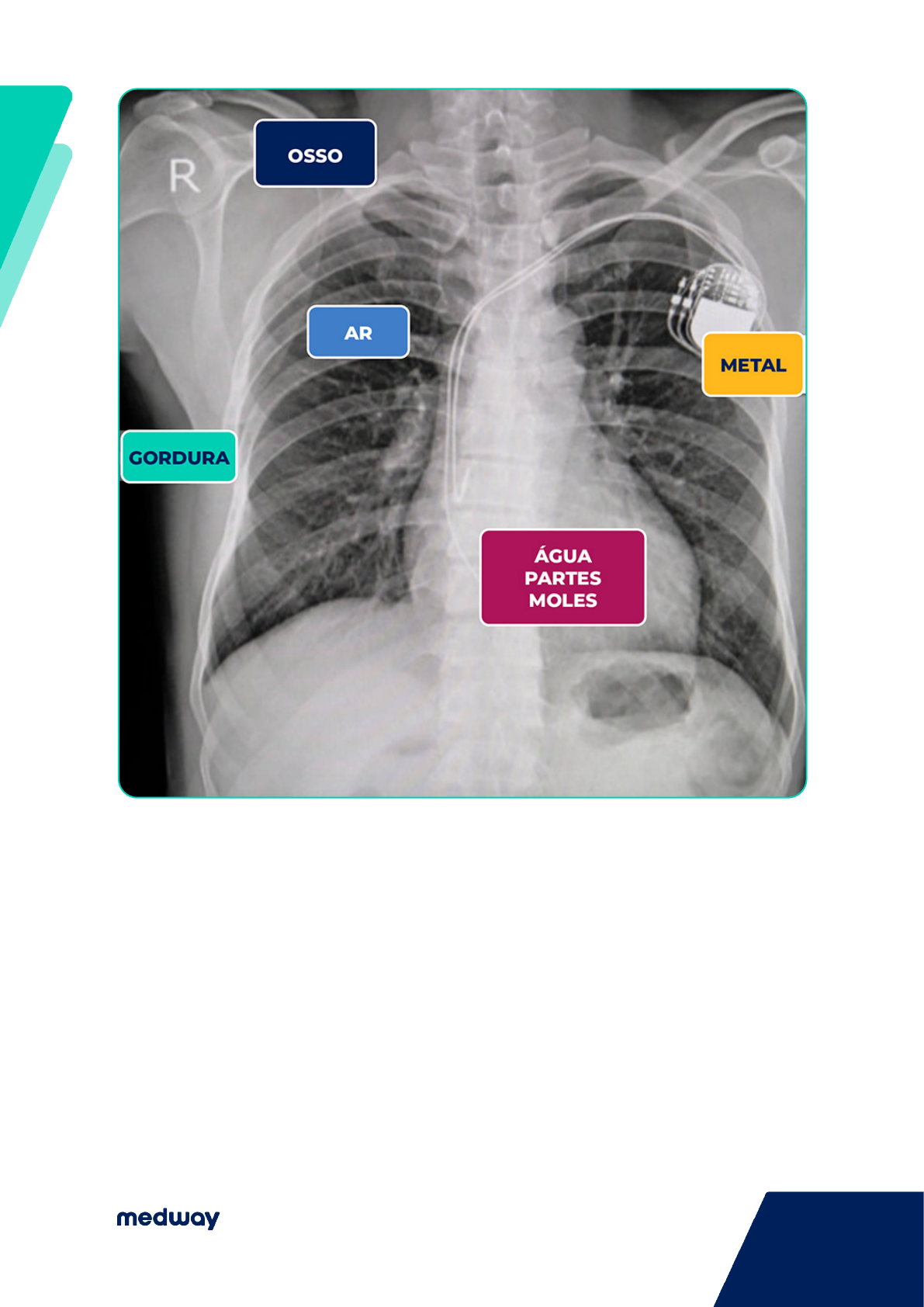 Grátis: Radiografia Torax abdome interativo 2 - Material Claro e Objetivo  em PDF para Estudo Rápido