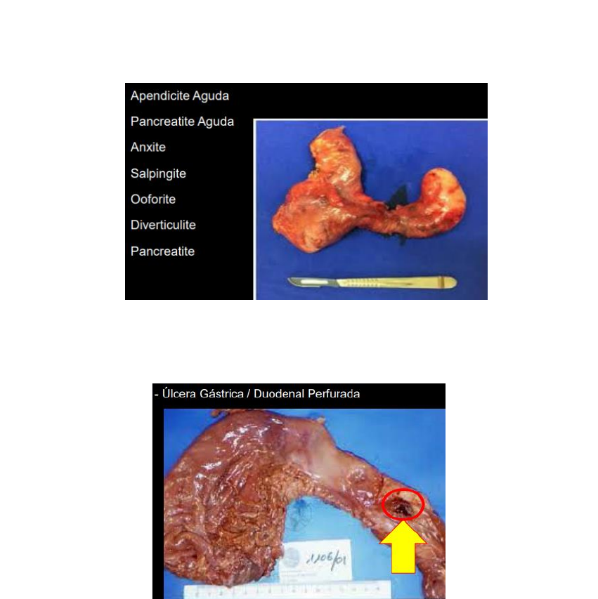 ABDOME AGUDO - Cirurgia Geral I