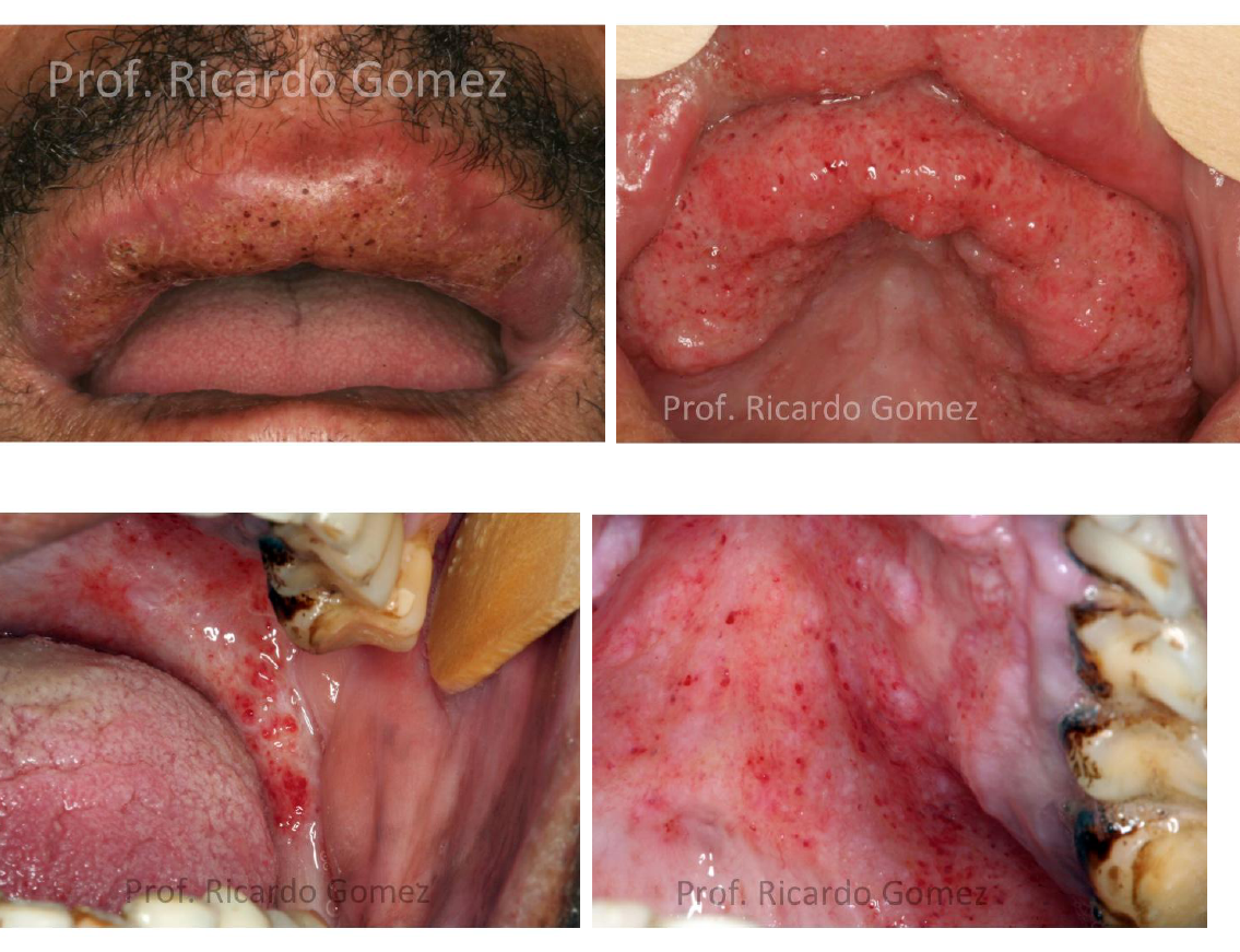 Candidíase Oral: Sintomas e Tratamento Eficaz, image size:1135x871