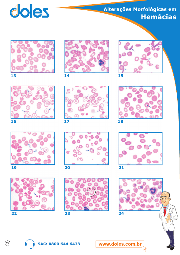 Alterações morfológicas em hemácias - Hematologia
