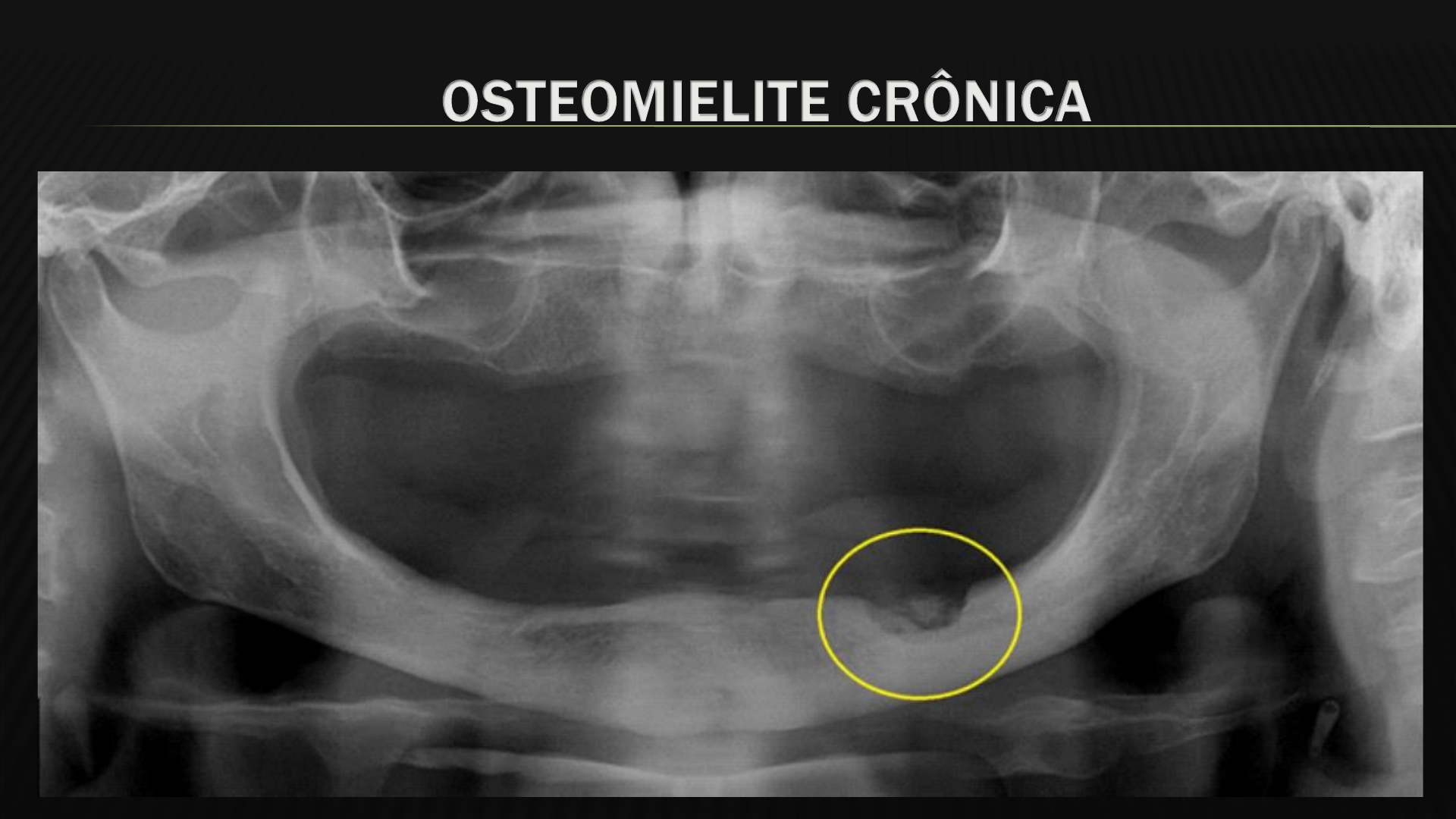 Grátis: ASPECTO RADIOGRAFICOS DAS LESÕES FIBRÓSSEAS E OSTOMIELITES -  Material Claro e Objetivo em PDF para Estudo Rápido, image size:1920x1080