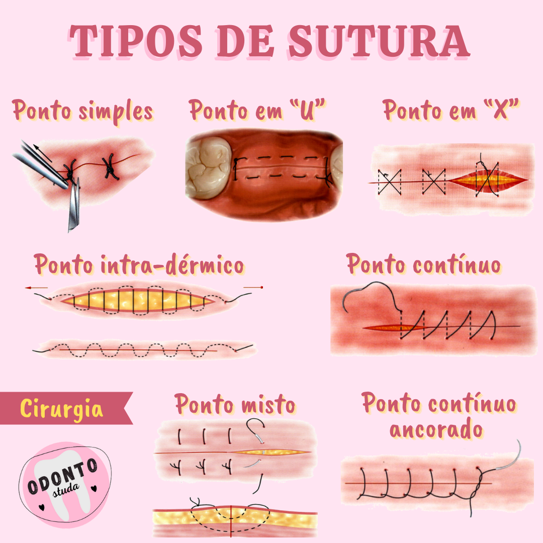 Tipos De Sutura Odontologia - BRAINCP