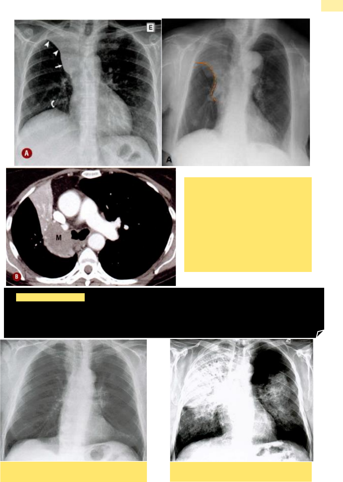Grátis: NeoplasiaCâncer de Pulmão - ImagemRadiologia - UC10P4Aula3 -  Material Claro e Objetivo em PDF para Estudo Rápido