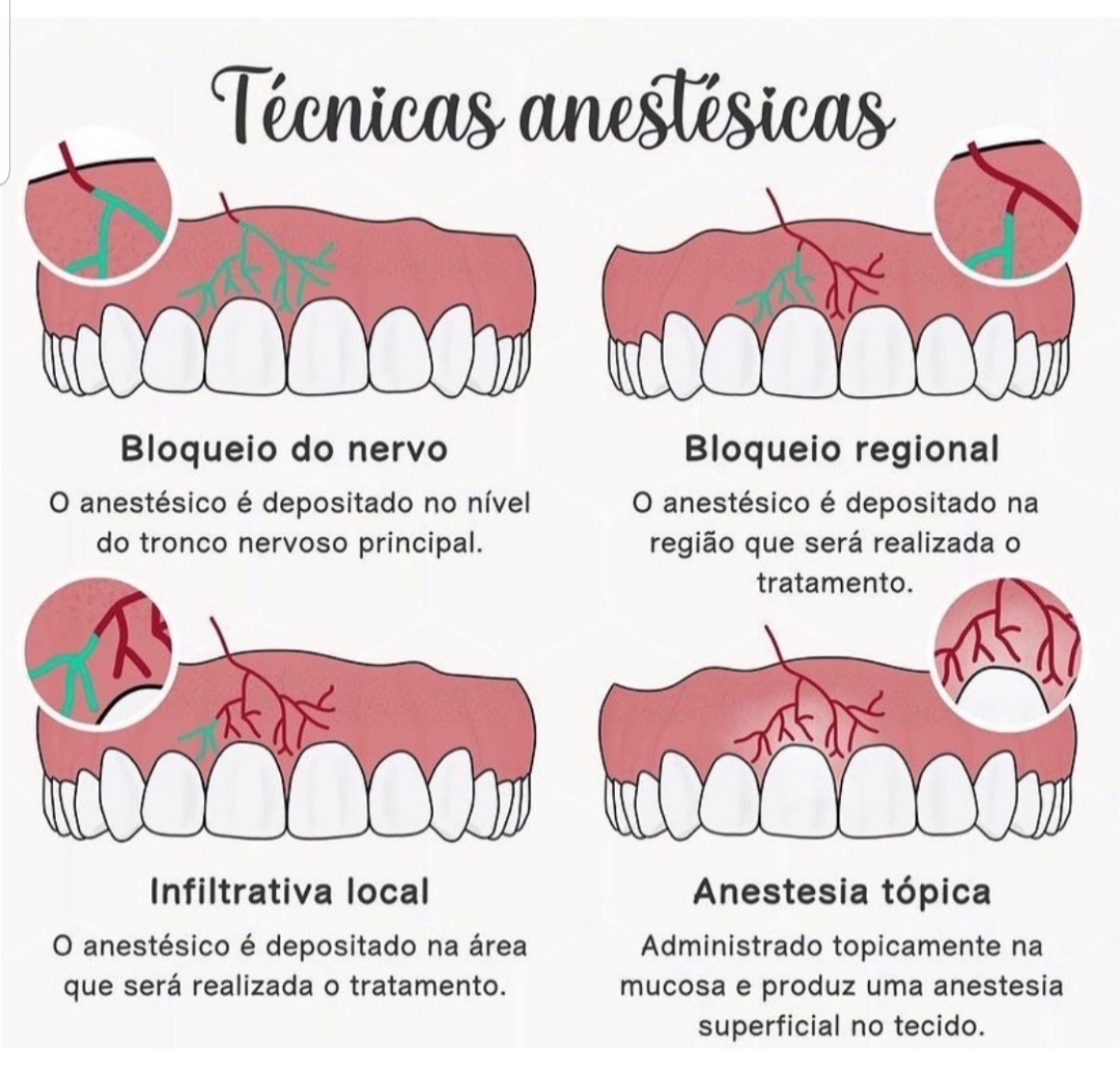 Técnicas Anestésicas - Cirurgia Buco-maxilo-facial