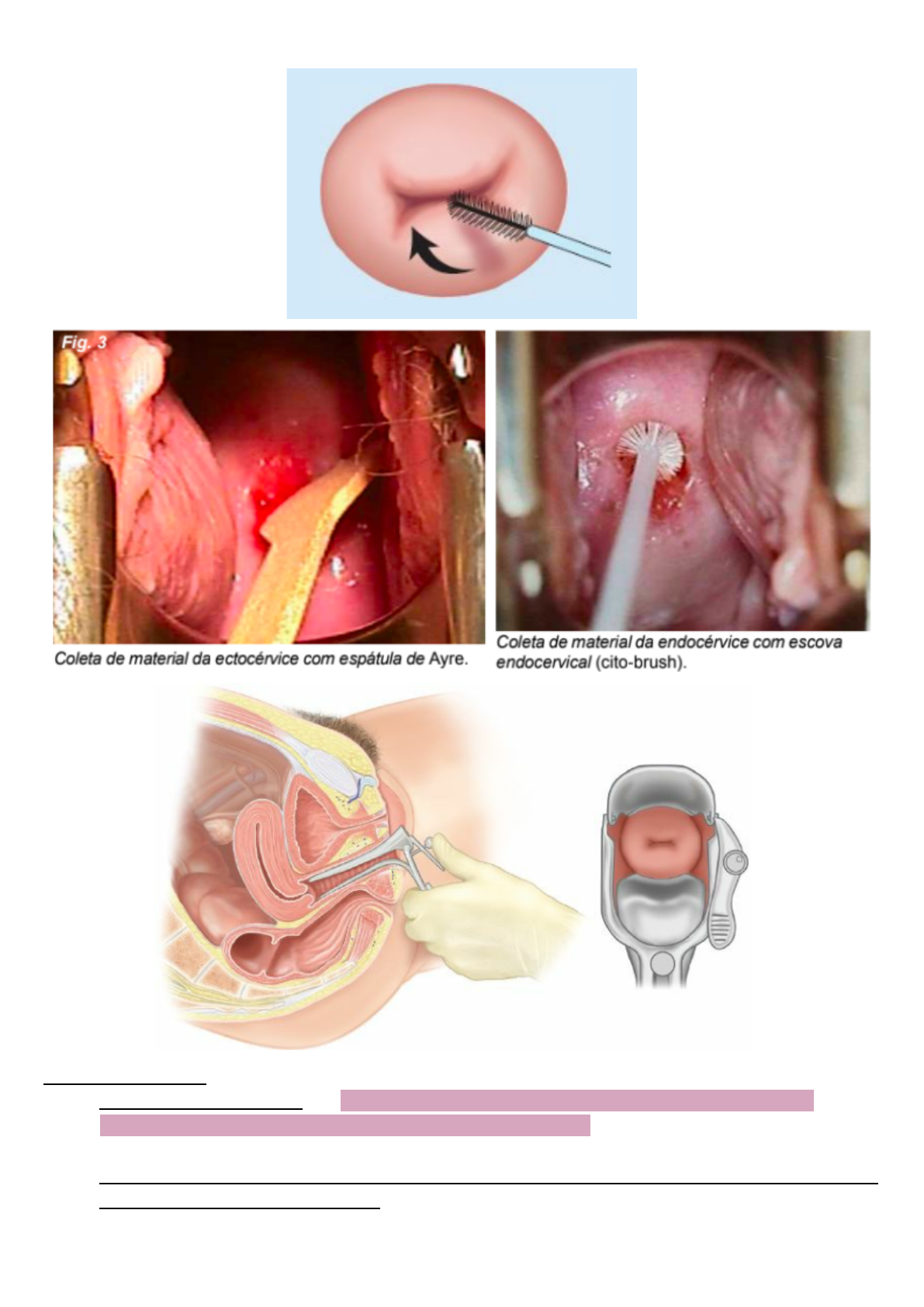 Grátis: NEOPLASIA COLO DE ÚTERO - Material Claro e Objetivo em PDF para  Estudo Rápido