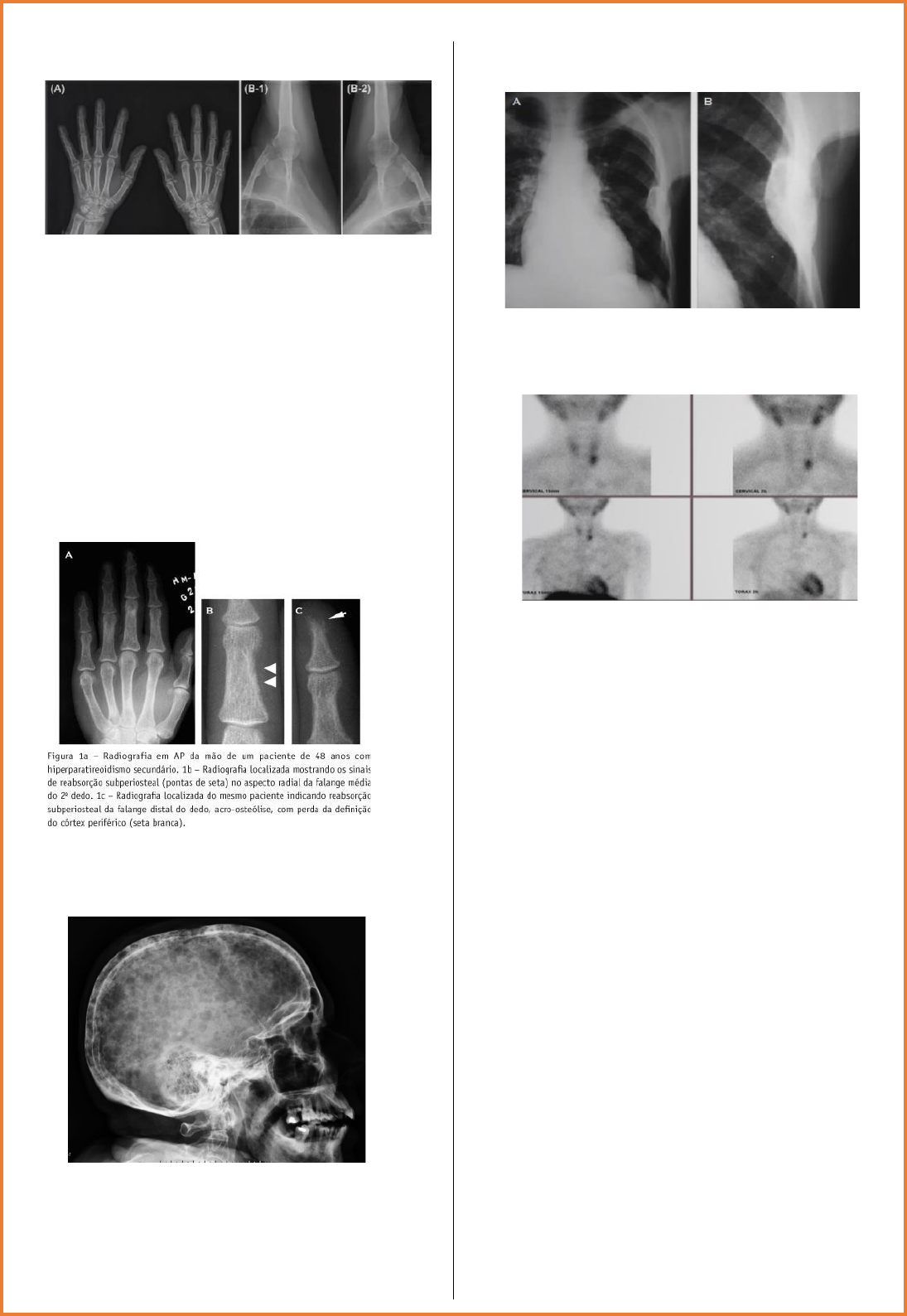 osteíte fibrosa cística radiografia