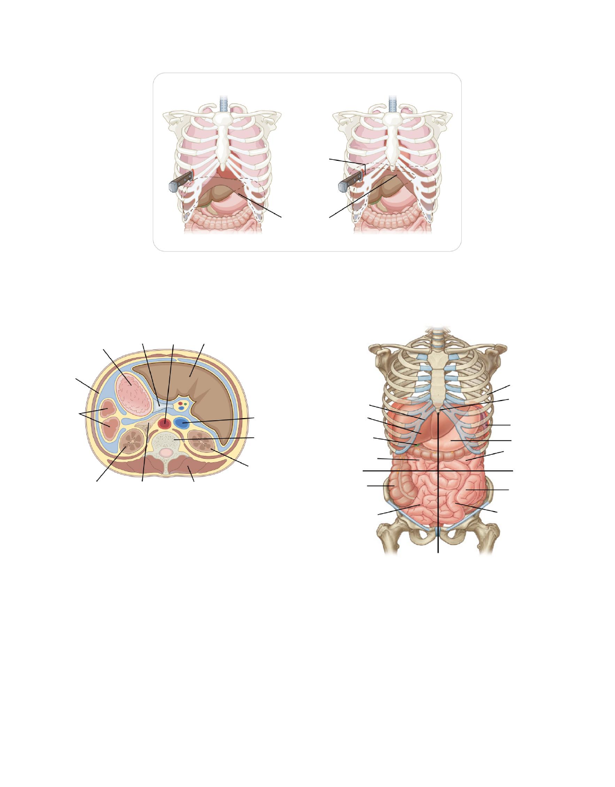 PHTLS - Cap 11 Trauma Abdominal - Emergências