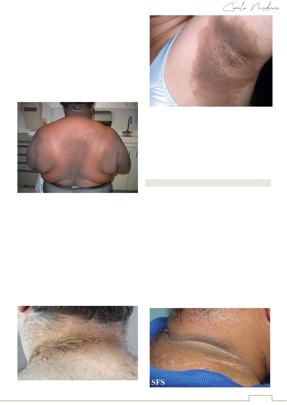 Tratamento De Acantose Nigricans Antes E Depois