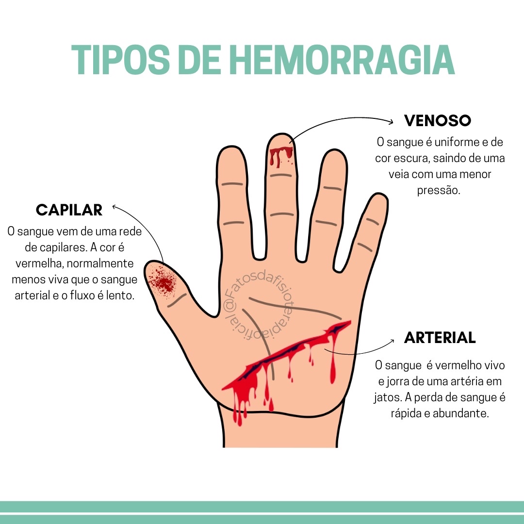 Tipos De Hemorragia Anatomia I