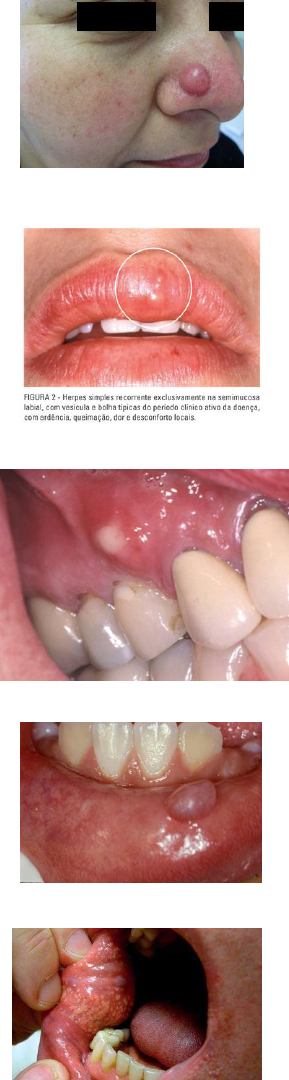 mcula melantica labial e perigoso - Hoogstra Manchas pigmentadas ao redor