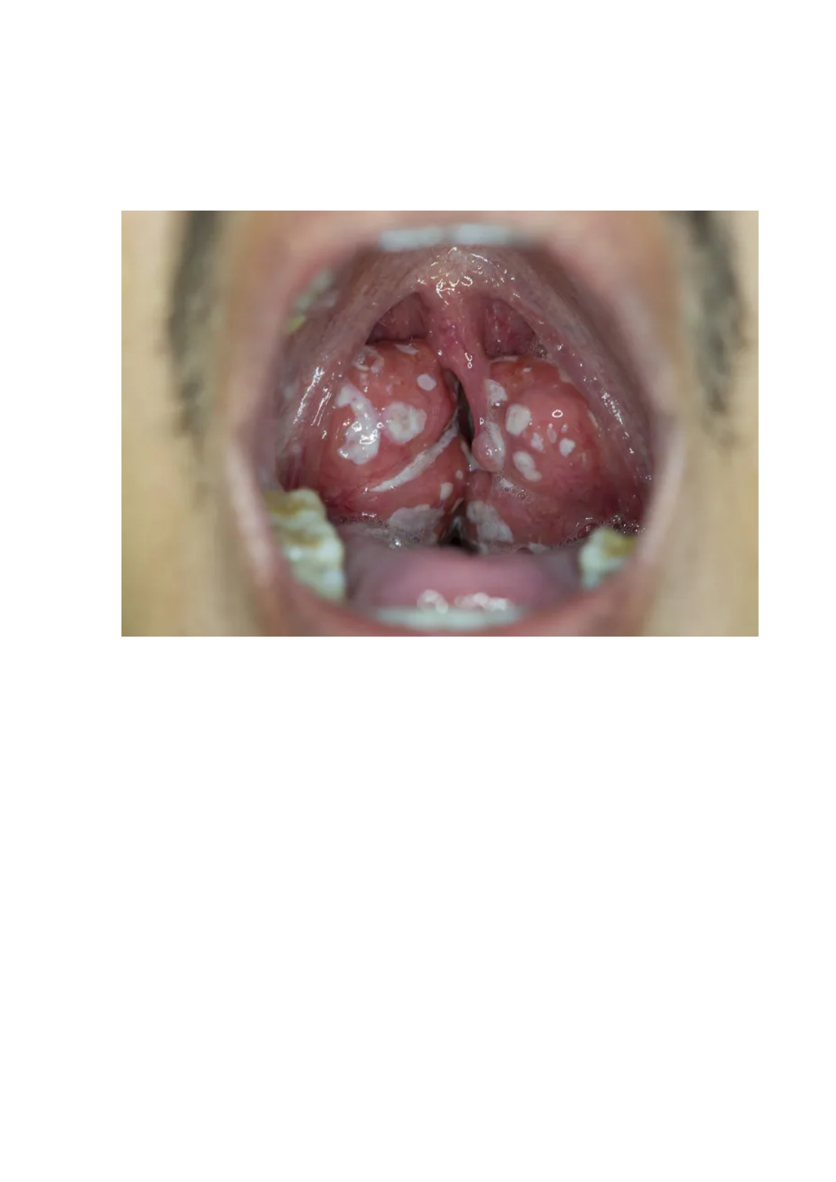 Grátis: Amigdalite em crianças - Material Claro e Objetivo em PDF para  Estudo Rápido, image size:1191x1684