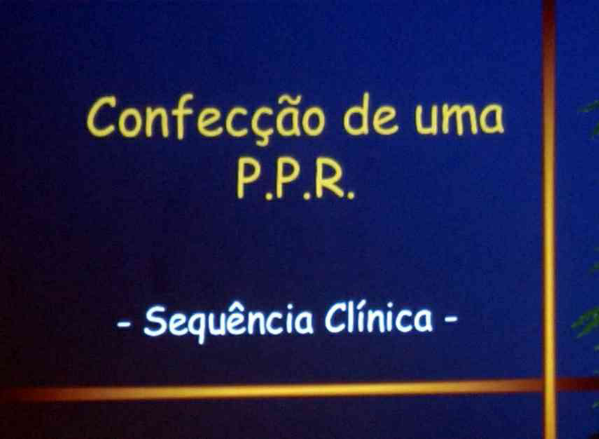 Confecção de uma PPR - Protese Parcial Removivel