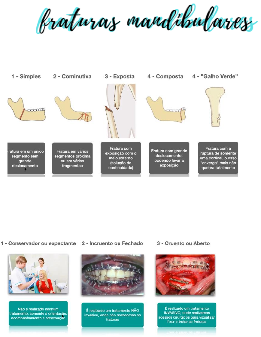 TRATAMENTO PARA Fratura Mandibular