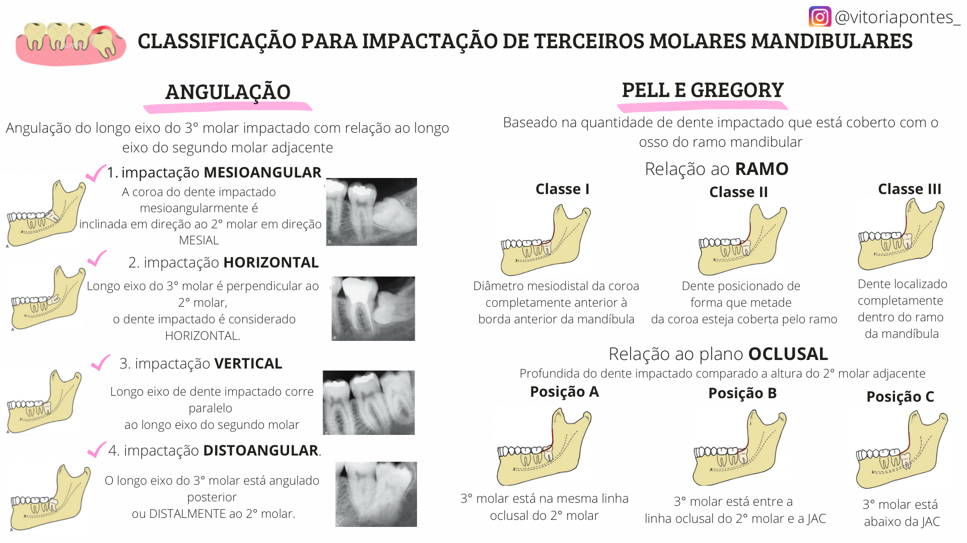 Classificação Para Impactação De Terceiros Molares Mandibulares