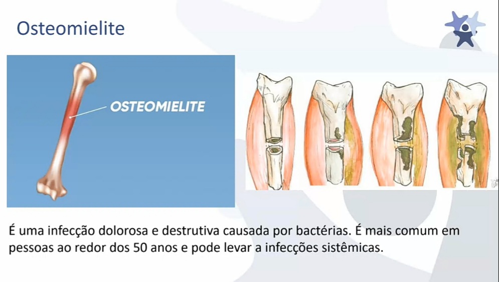 Osteomielite - Anatomia Aplicada à Enfermagem