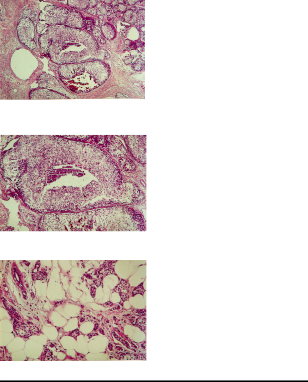 Carcinoma Primário de Mama Acessória Axilar – Relato de Caso - Ginecologia
