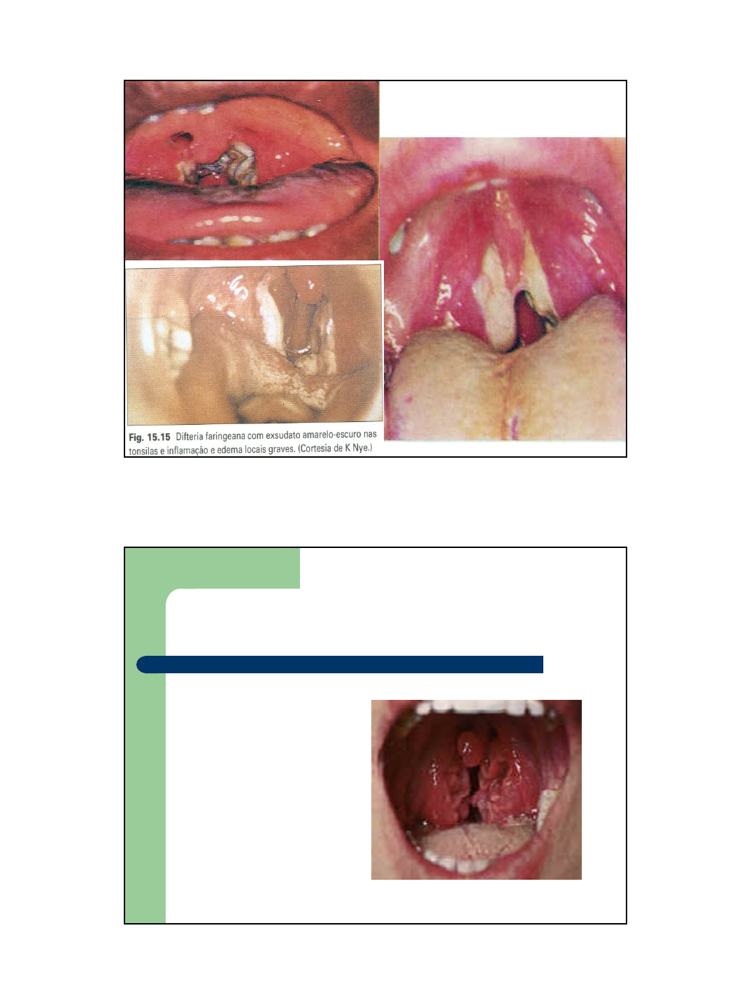 Grátis: Tonsilite - Material Claro e Objetivo em PDF para Estudo Rápido, image size:1074x1436